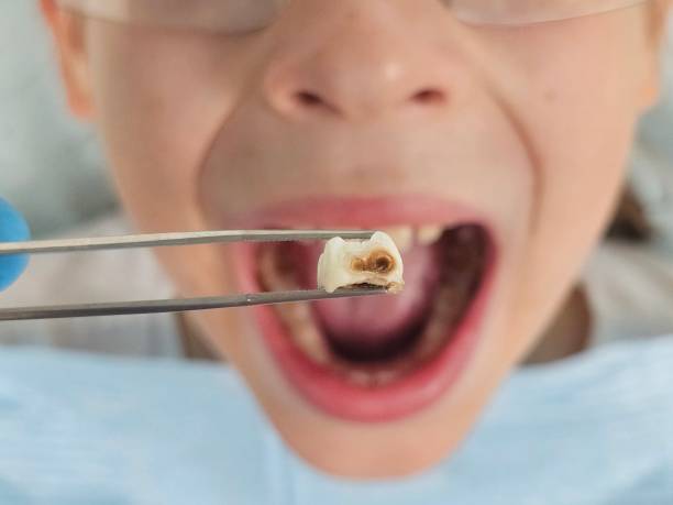Best Emergency Wisdom Teeth Removal in Raynham Center, MA